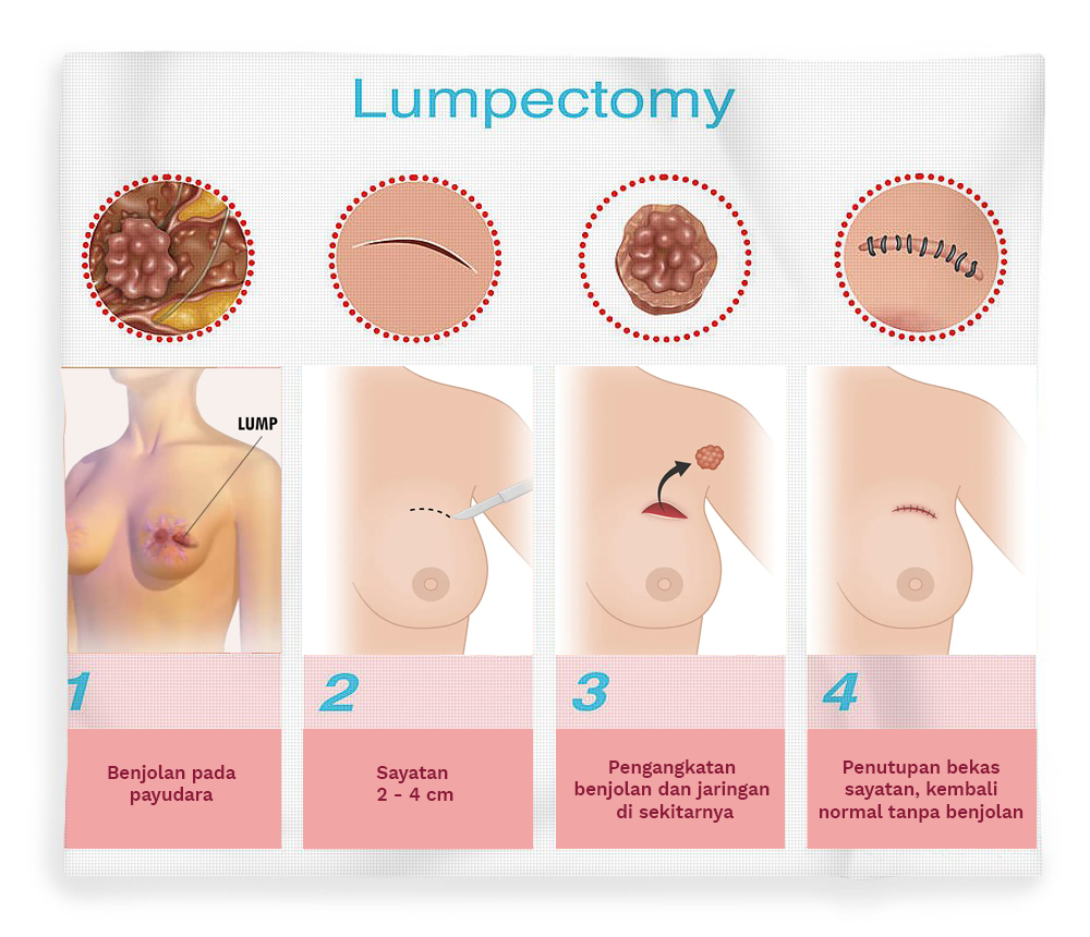 lumpectomy-illustration-gwen-shockey